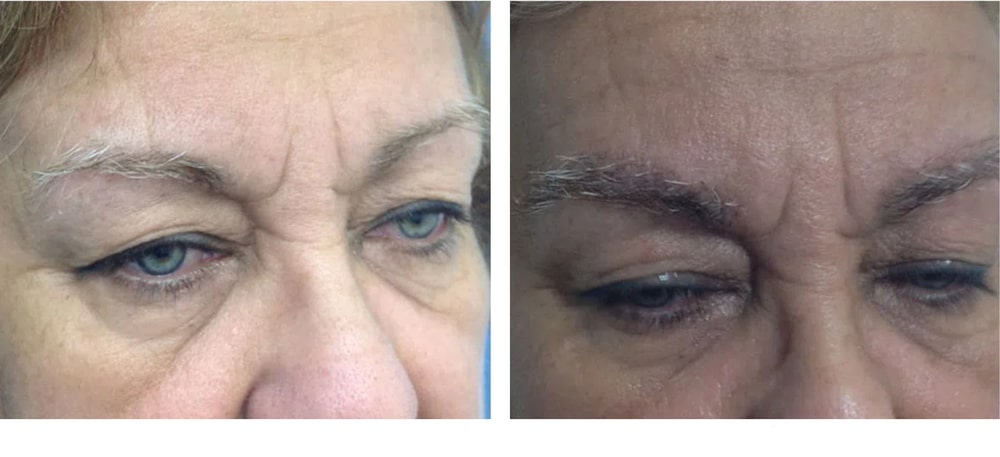 Hair Restoration Results Before and After