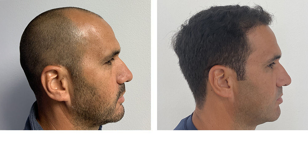 Hair Restoration Results Before and After