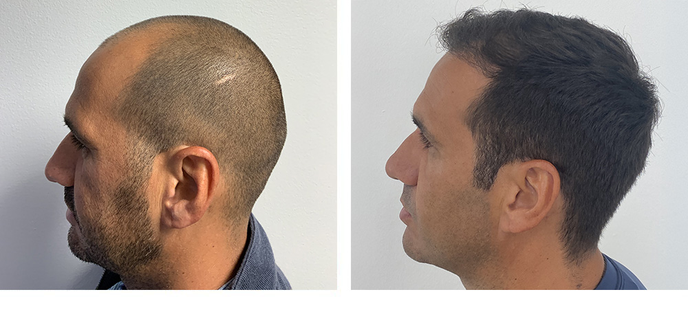 Hair Restoration Results Before and After
