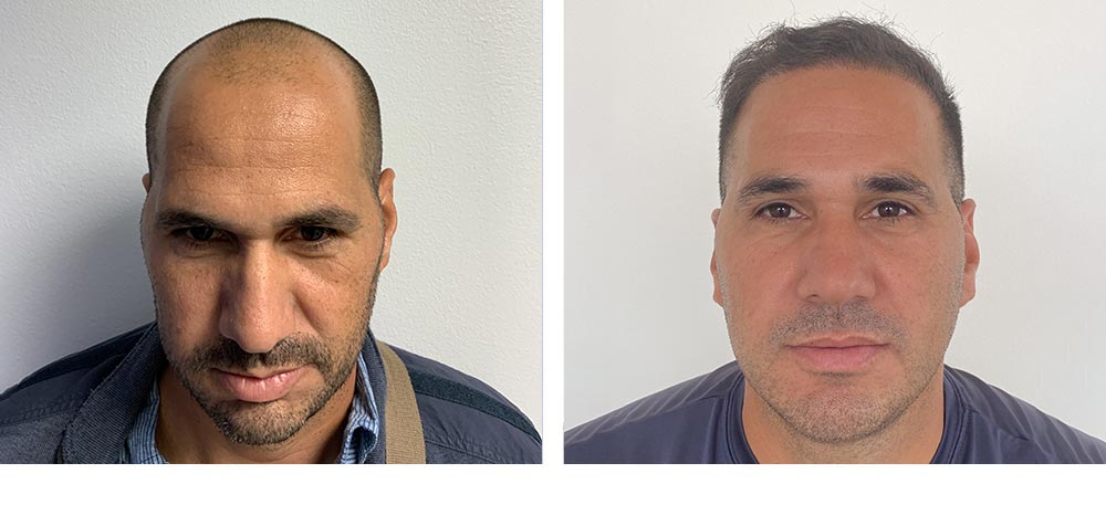 Hair Restoration Results Before and After