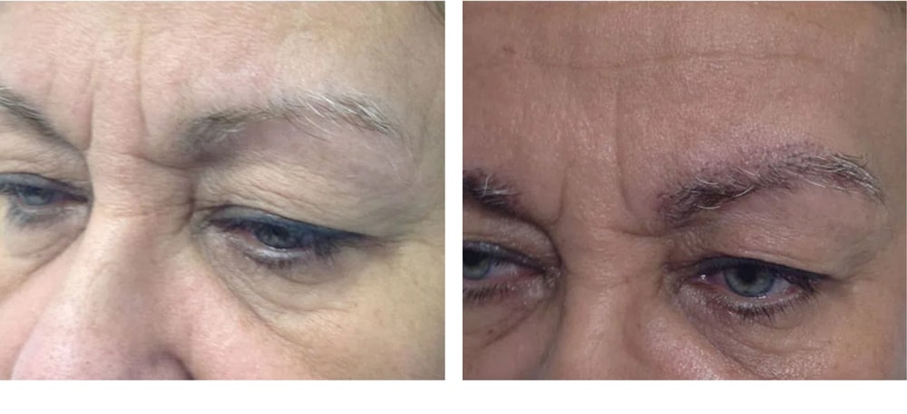 Hair Restoration Results Before and After