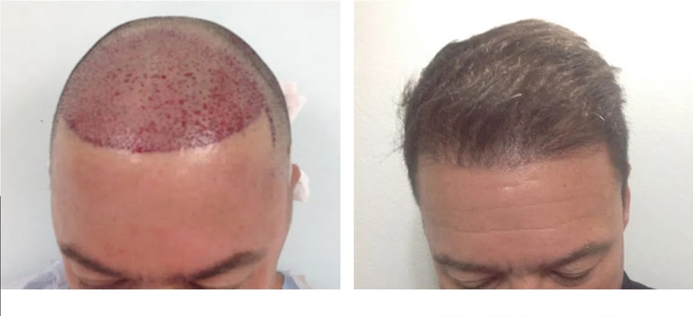 Hair Restoration Results Before and After