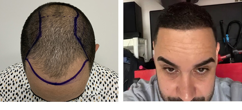 Hair Transplant Before And After in Miami
