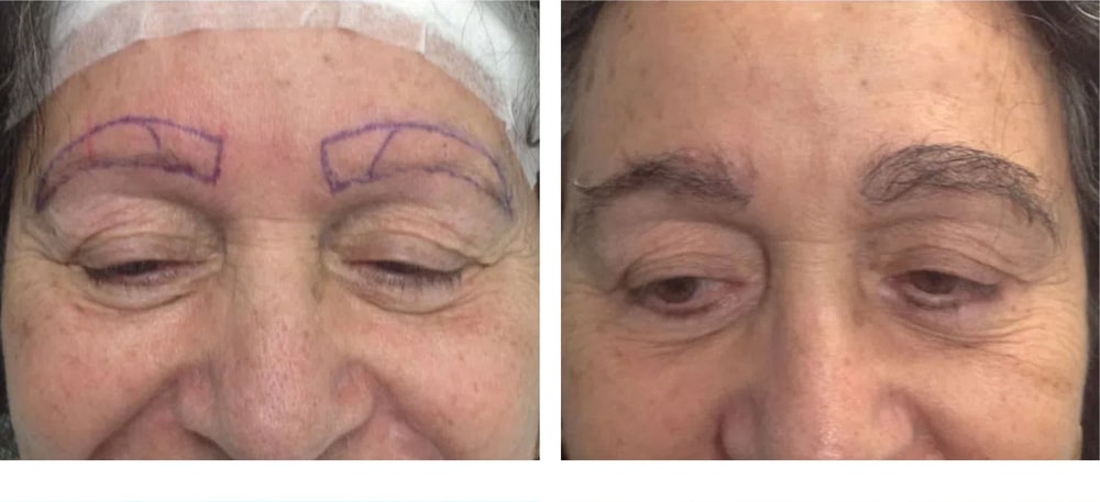 Hair Restoration Results Before and After