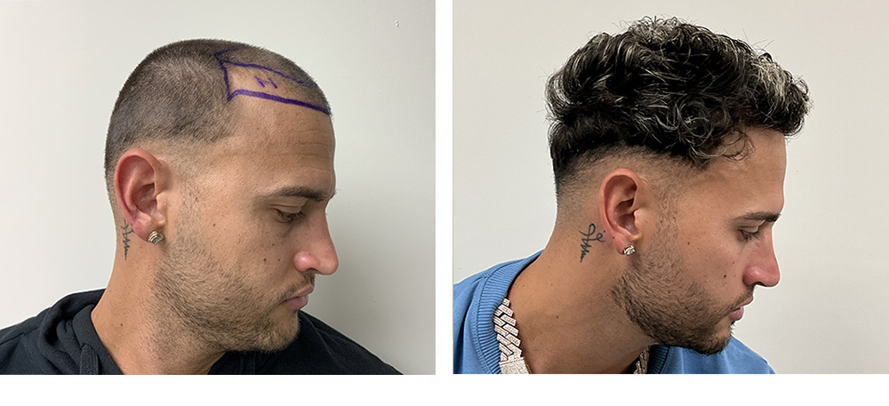 Hair Transplant Before and After