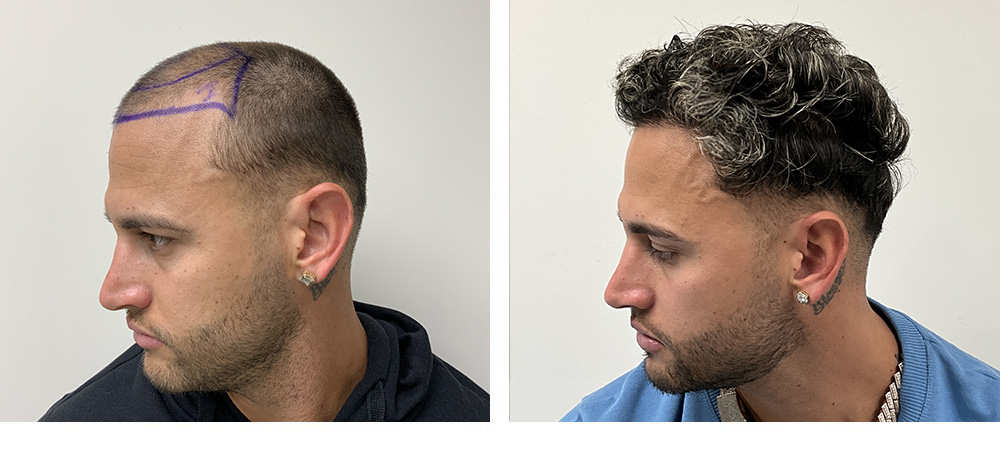 Hair Transplant Before and After