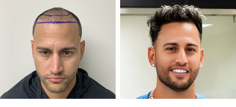 Hair Transplant Before and After