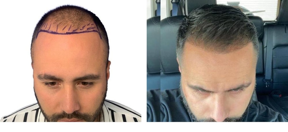 Hair Restoration Results Before and After