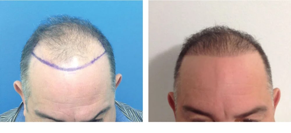 Hair Restoration Results Before and After