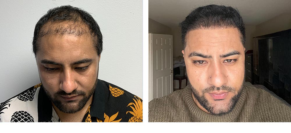 Hair Restoration Results Before and After