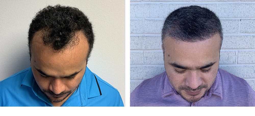 Hair Restoration Results Before and After