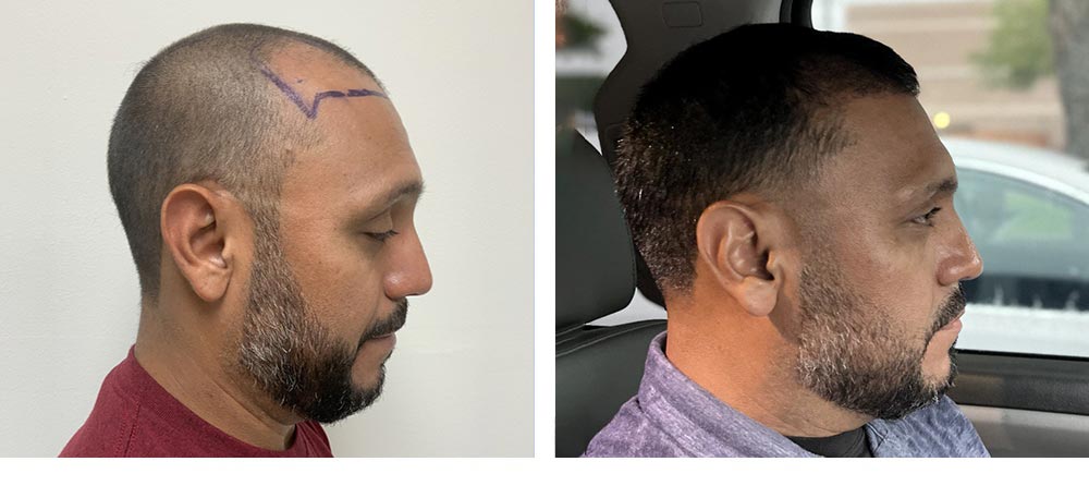 Hair Restoration Results Before and After