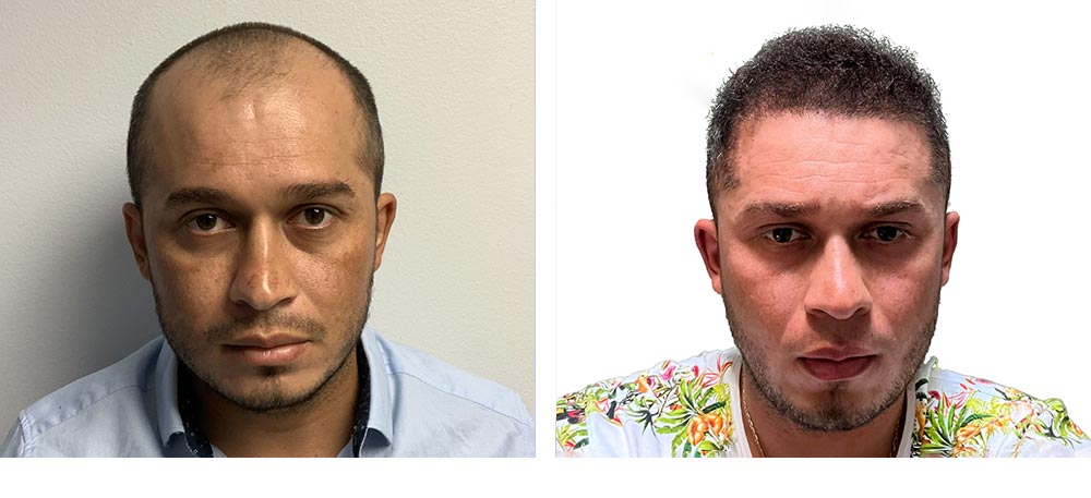 Hair Restoration Results Before and After