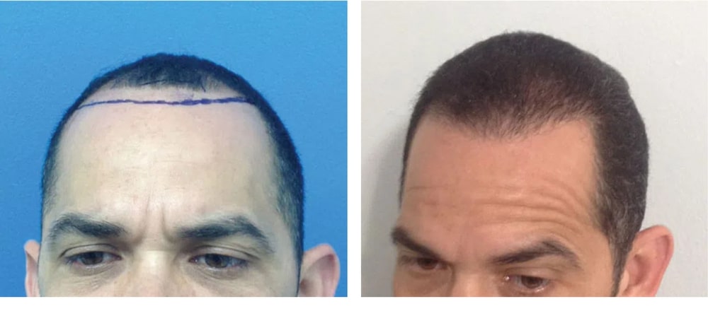 Hair Restoration Results Before and After