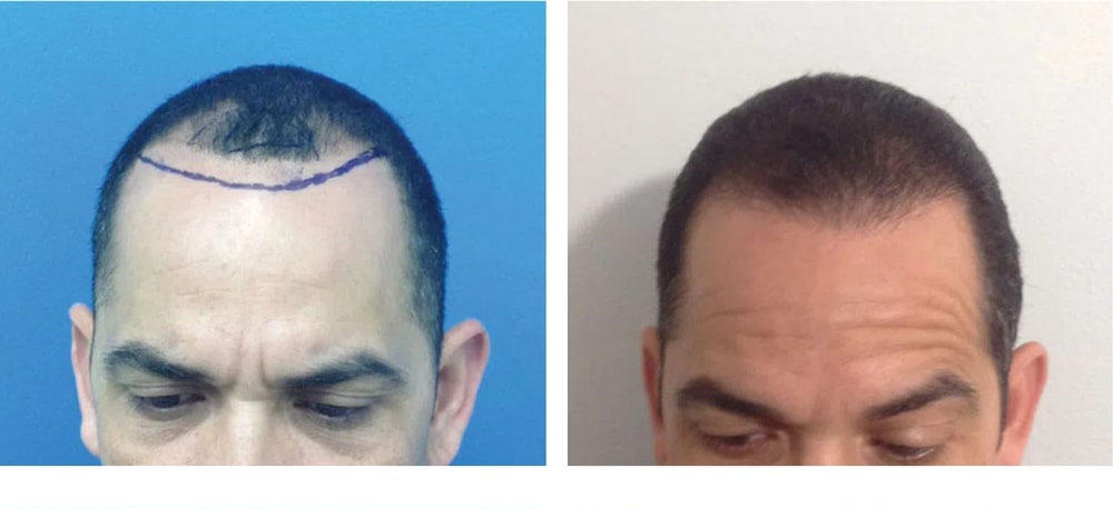 Hair Restoration Results Before and After