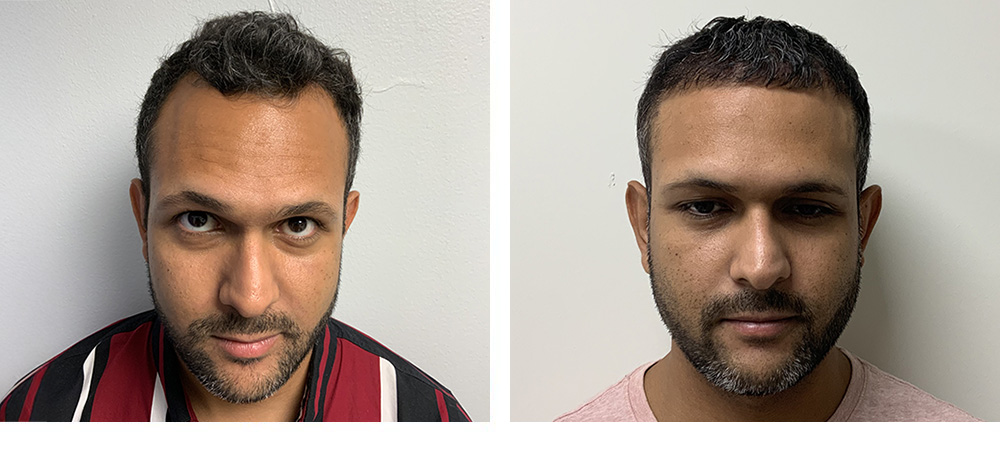 Hair Transplant Before and After
