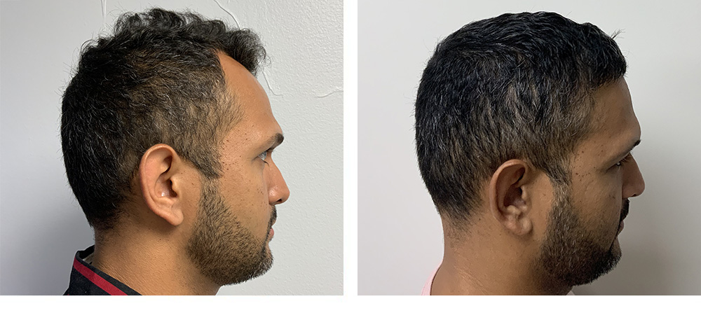 Hair Transplant Before and After