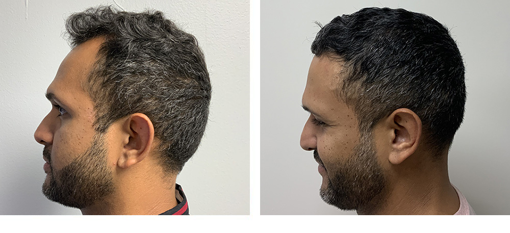 Hair Transplant Before and After
