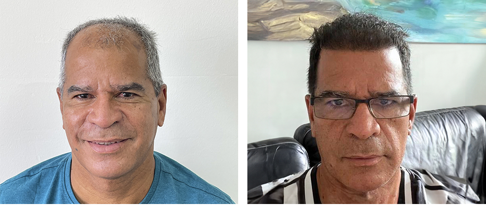 Hair Restoration Results Before and After