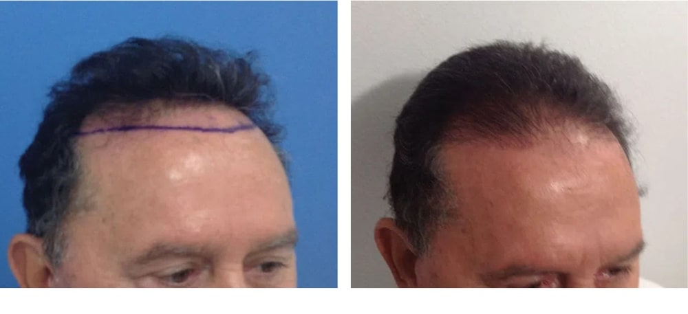 Hair Restoration Results Before and After