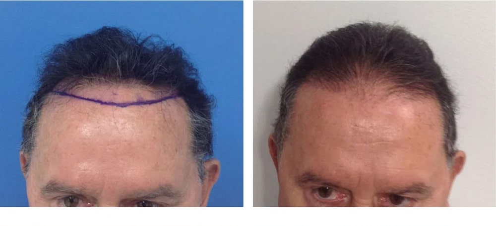 Hair Restoration Results Before and After