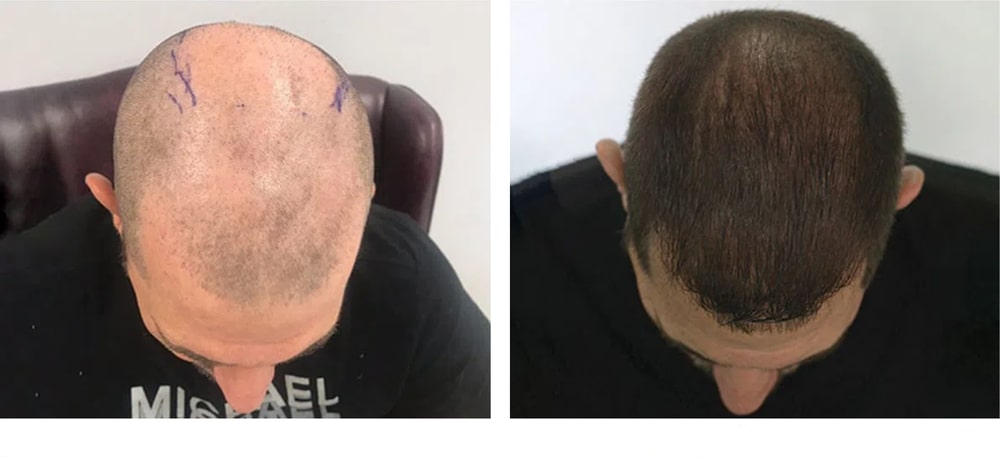 Hair Restoration Results Before and After