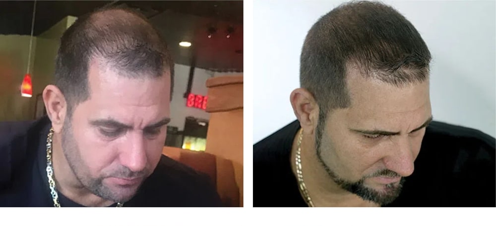 Hair Restoration Results Before and After