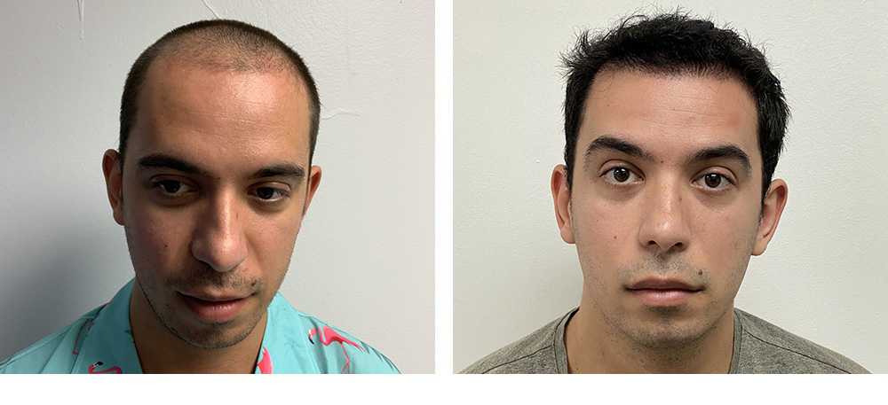 Hair Restoration Results Before and After