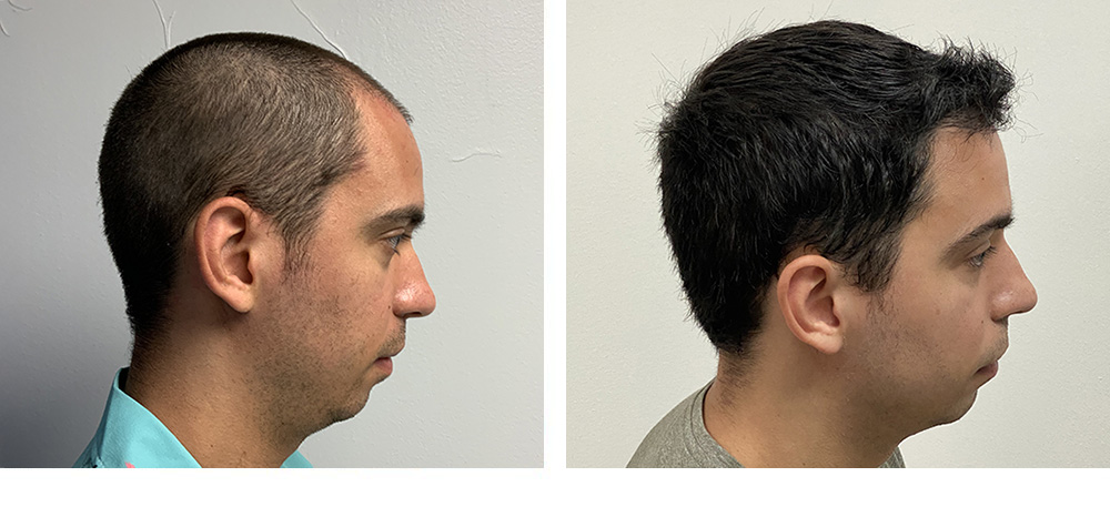 Hair Restoration Results Before and After