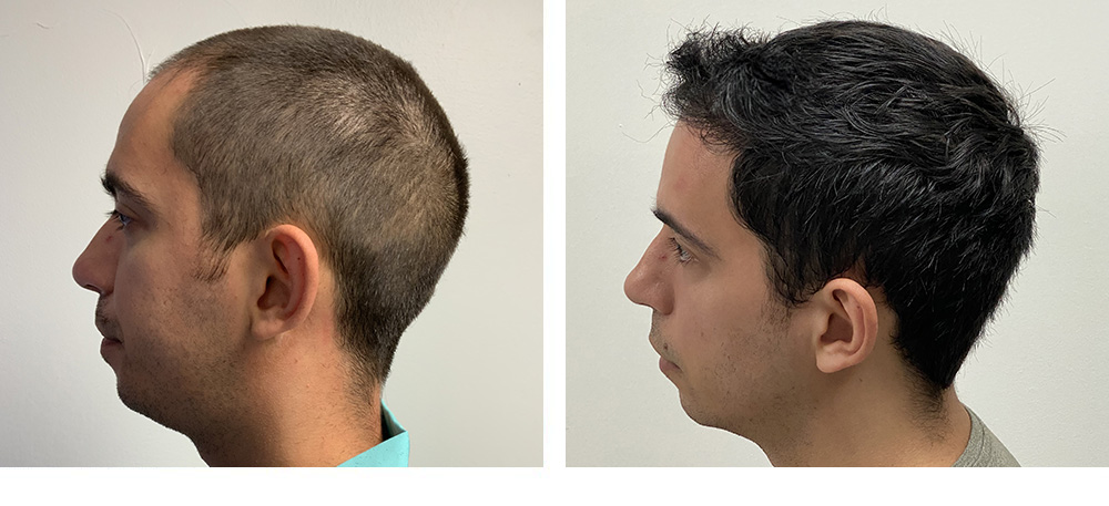Hair Restoration Results Before and After
