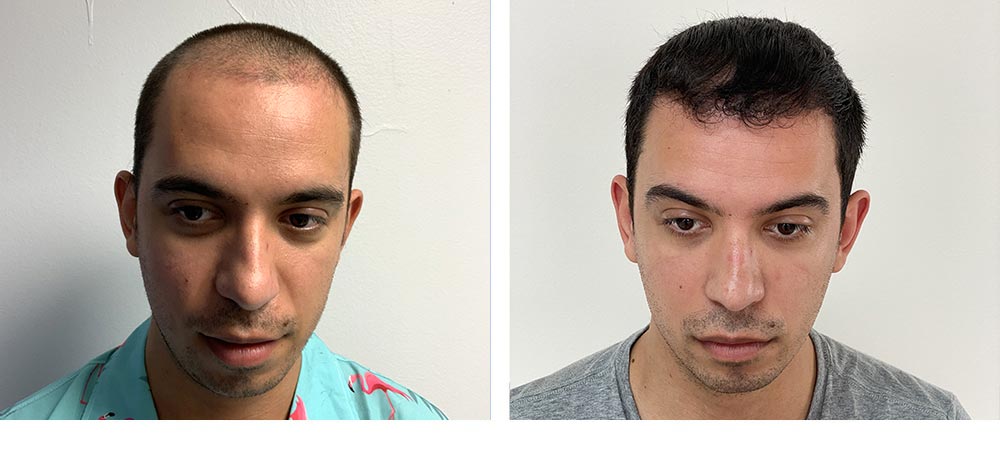 Hair Restoration Results Before and After
