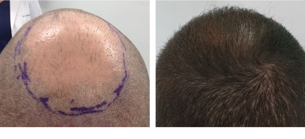 Hair Restoration Results Before and After