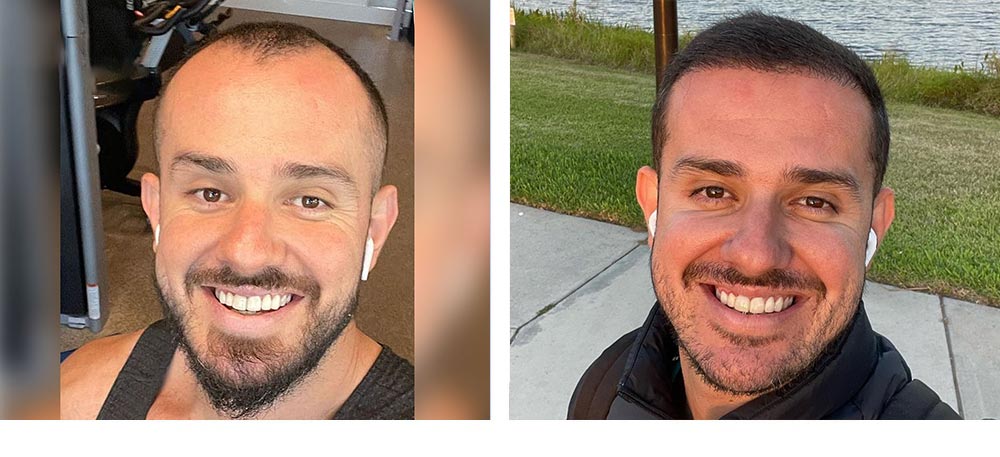 Hair Restoration Results Before and After
