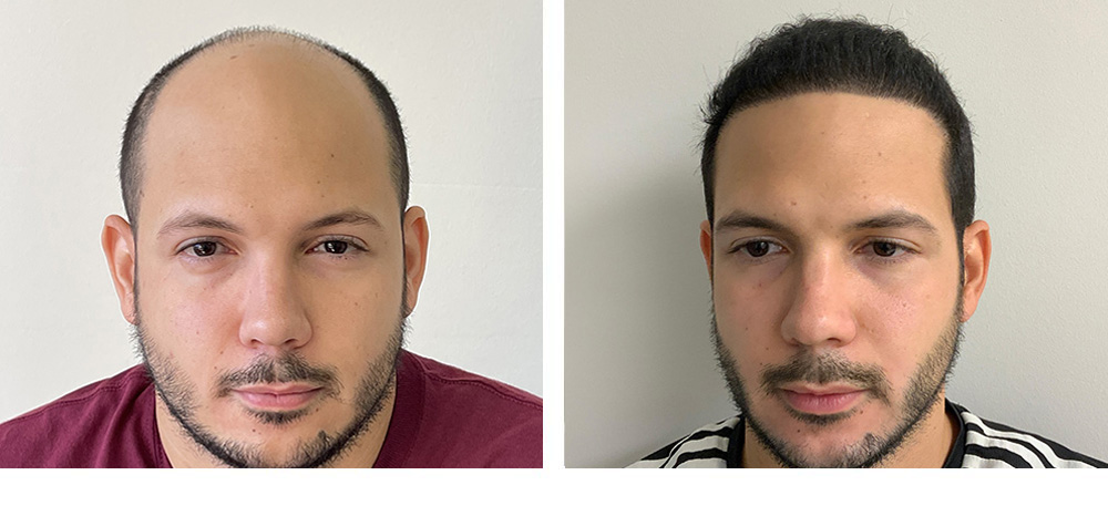 Hair Transplant Before And After in Miami