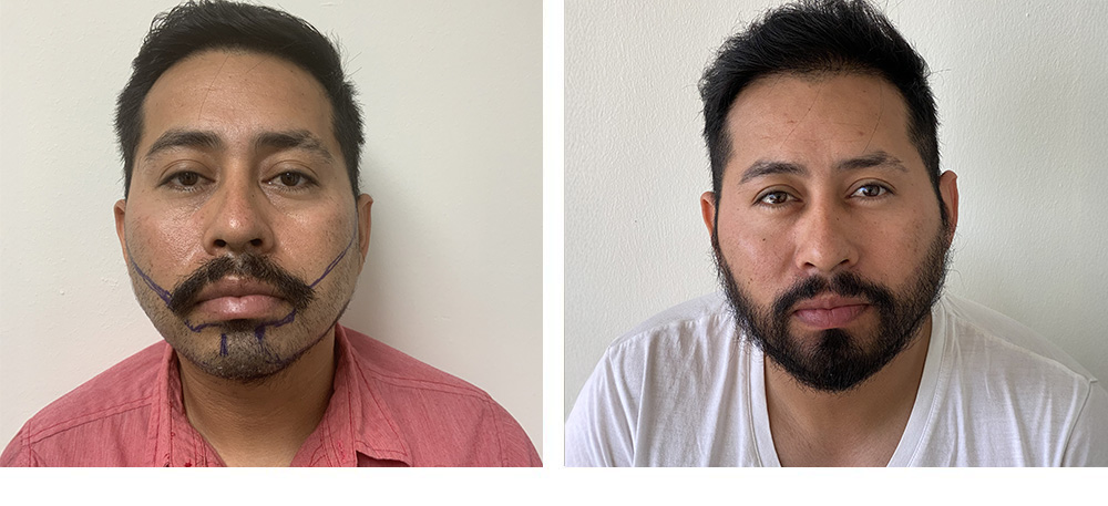 Hair Restoration Results Before and After