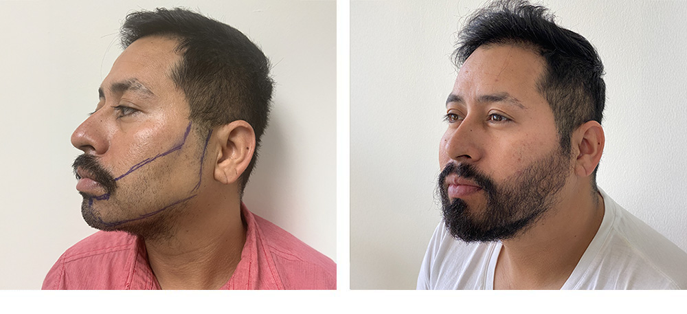 Hair Restoration Results Before and After