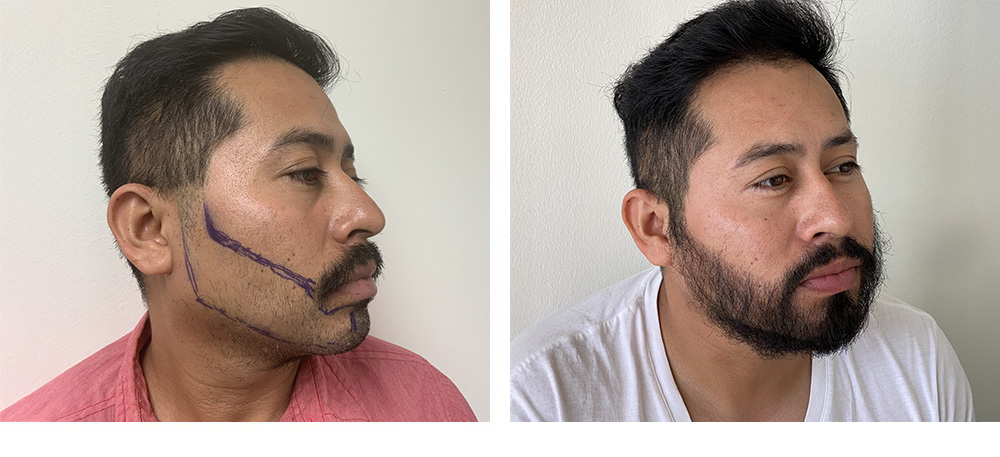 Hair Restoration Results Before and After