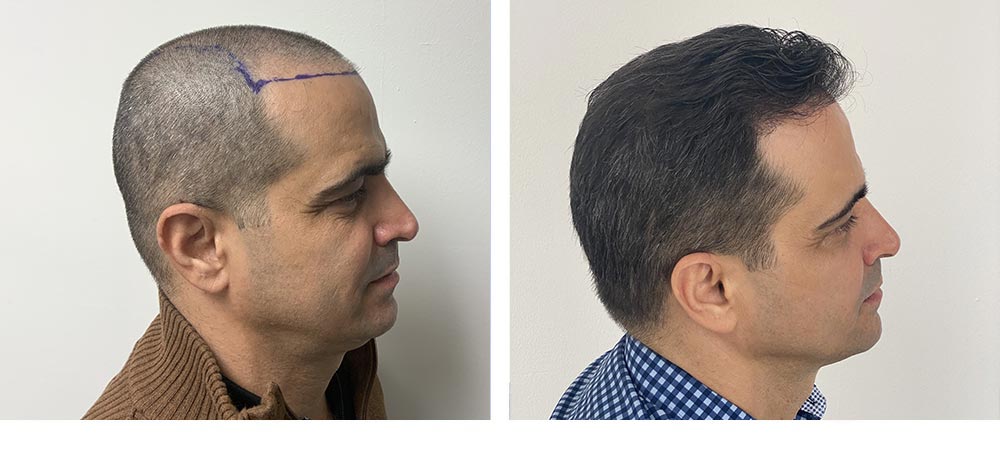 Hair Restoration Results Before and After