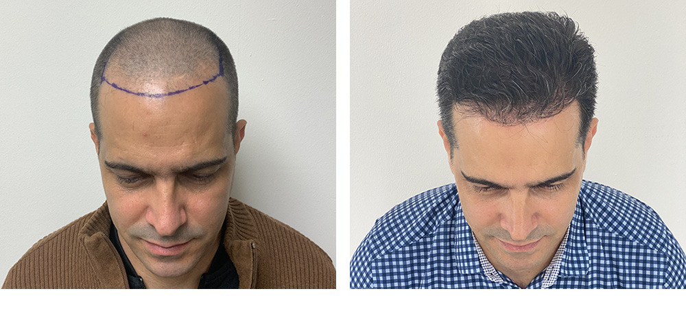 Hair Restoration Results Before and After