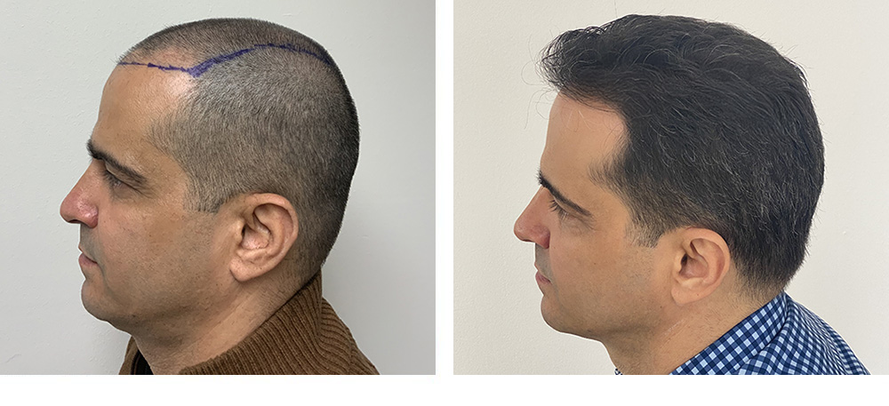 Hair Restoration Results Before and After