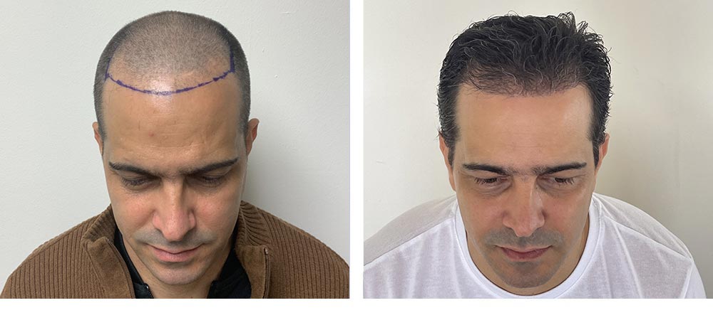 Hair Restoration Results Before and After