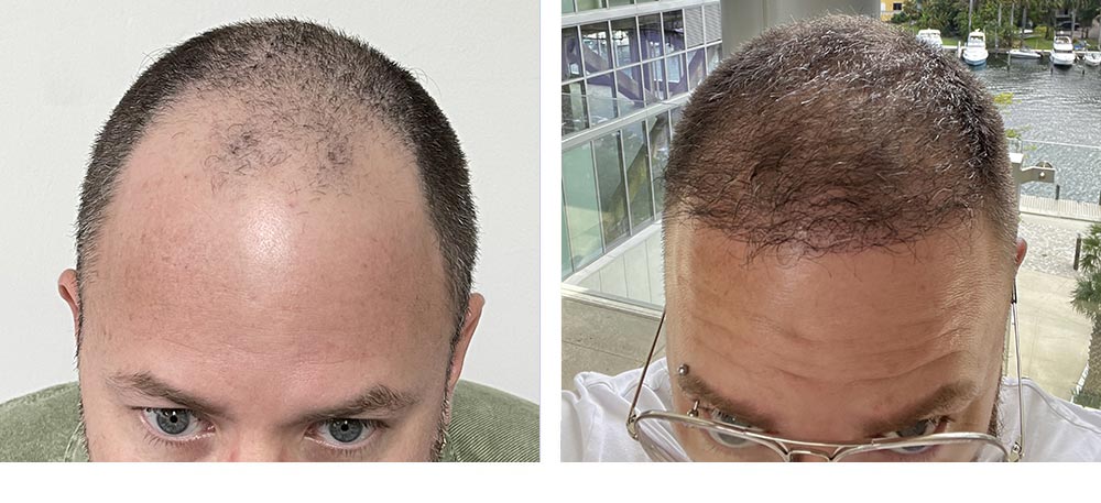 Hair Restoration Results Before and After