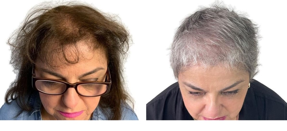 Hair Restoration Results Before and After