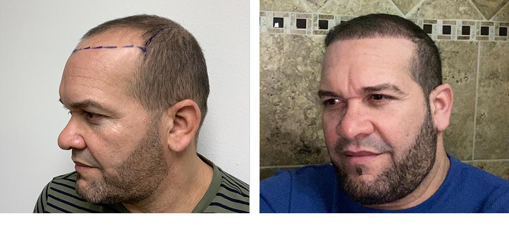 Hair Restoration Results Before and After