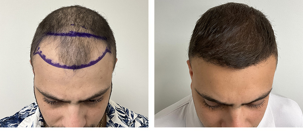 Hair Transplant before and after