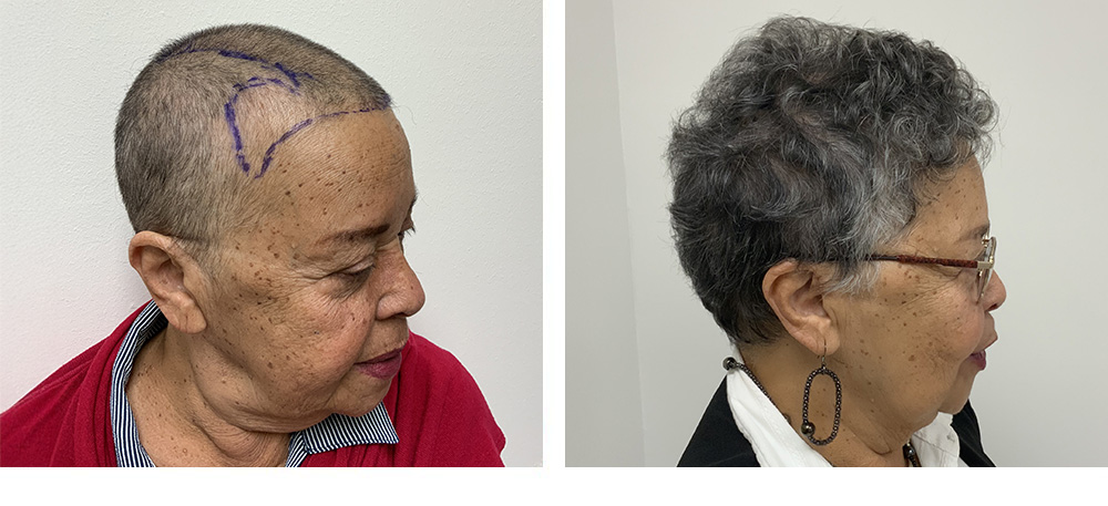 Hair Restoration Results Before and After