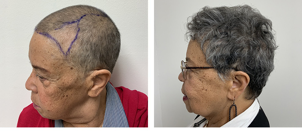 Hair Restoration Results Before and After