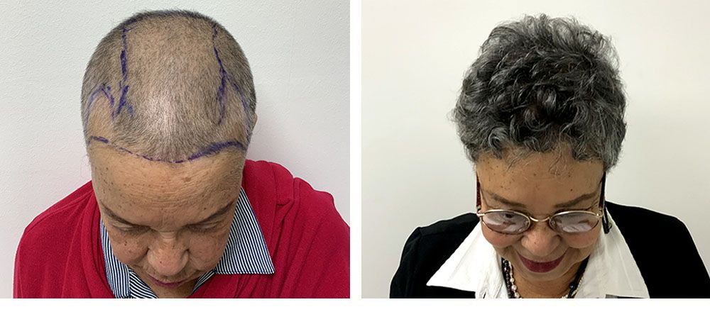 Hair Restoration Results Before and After
