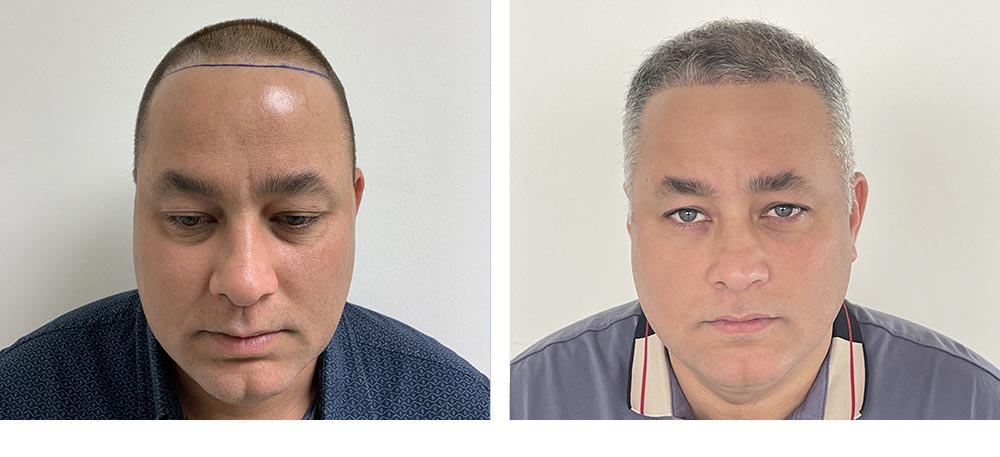 Hair Restoration Results Before and After