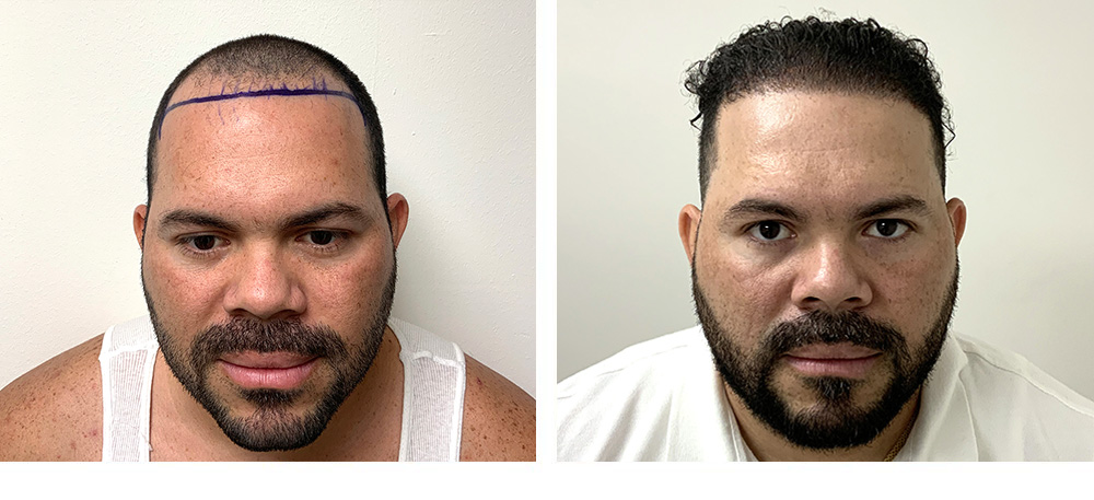 Hair Restoration Before and After